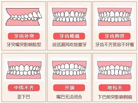 正确的牙齿咬合图是什么样的深圳爱康健口腔医院官网