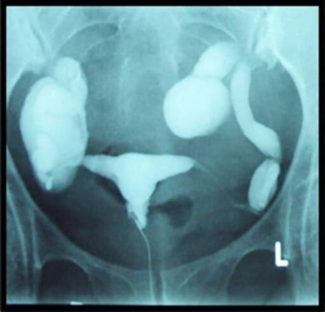 Retroverted Uterus Hsg