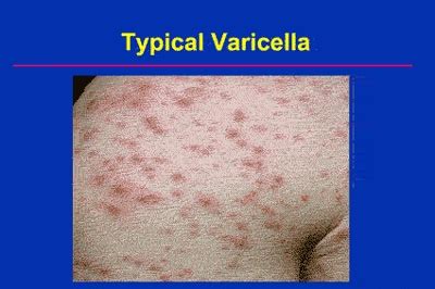 Varicella Immunization Current Status And Practice