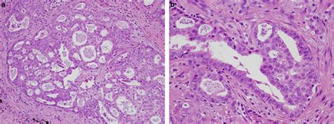 Cribriform Adenocarcinoma Of The Lung Clinicopathologic