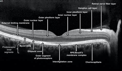 Comly Eye Care — Understanding Optical Coherence Tomography Oct What