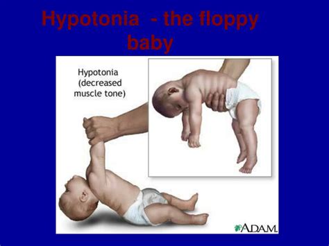 PPT Hypotonia The Floppy Baby PowerPoint Presentation ID 179308