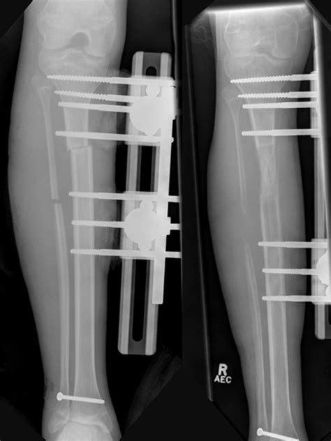 Mackie Orthopaedics Bone Deformity Correction