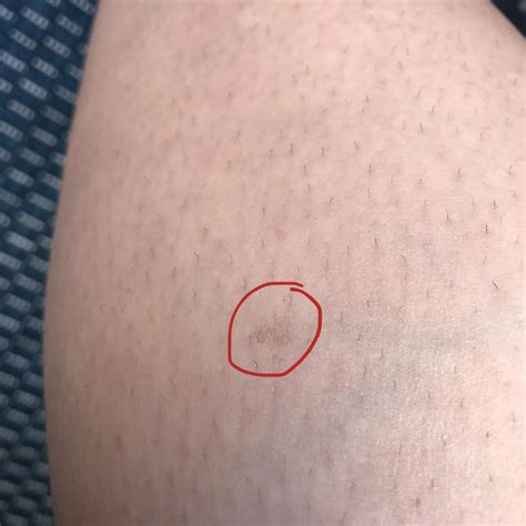 Whats The Best Way To Fade Sunspots And Scars Like These Looking For