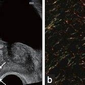 Elastography of prostate cancer (stiff lesion). (a) A hypoechoic lesion ...