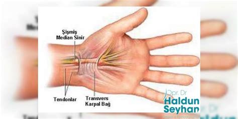 Karpal T Nel Sendromu Op Dr Haldun Seyhan