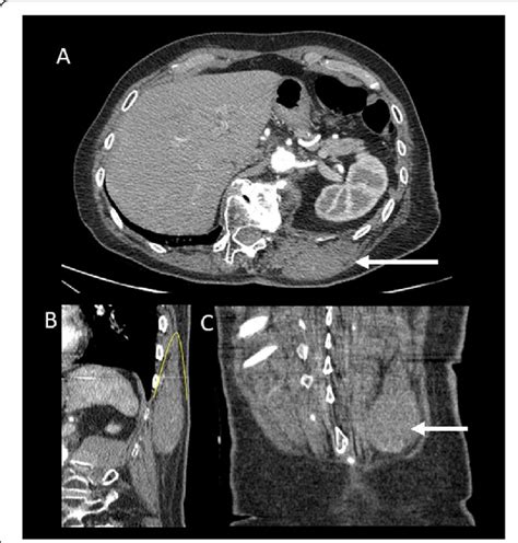 Hodgkins Lymphoma Radiology