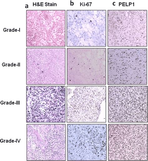 Representative Photo Micrographs Of Different Grades Of Astrocytomas