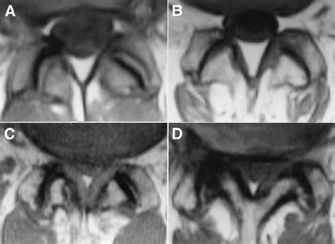 Facet Joints Musculoskeletal Key