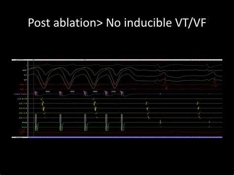 Catheter Ablation Of Ventricular Tachycardia