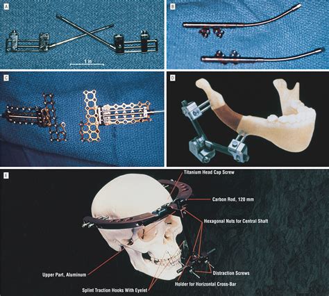 The Versatility Of Distraction Osteogenesis In Craniofacial Surgery