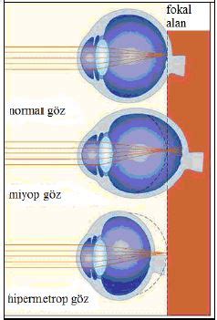 Miyop Astigmat Nedir