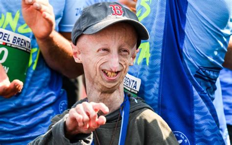 Sammy Basso Donato Il Suo Corpo Alla Ricerca Sulla Progeria Un Suo