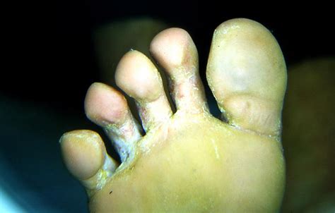 Superficial Fungal Infections Tinea Pedis Athlet S Foot Picture Hellenic Dermatological