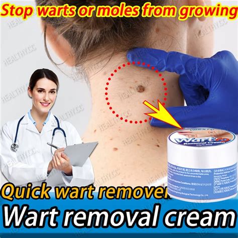 Warts Remover Original Cream Kasoy Oil Cream Kulugo Mole Skin Tag Wart