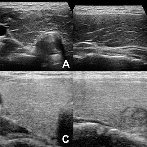 Sonography Of Ht A Longitudinal And B Transverse Sonogram Of Ht Download Scientific