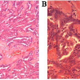 Histological Appearance Of Thyroidlike Lowgrade Nasopharyngeal