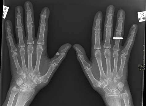 calcifications   ray calcifications  medical imaging
