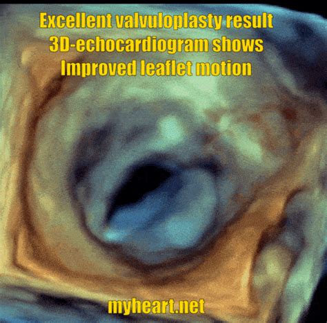 Improved Leaflet Motion After Mitral Valvuloplasty Relieving The Mitral