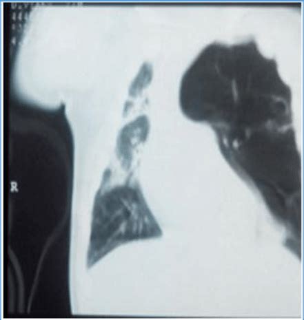 CT Thorax Showing Left Upper Lobe Congenital Lobar Emphysema CLE With