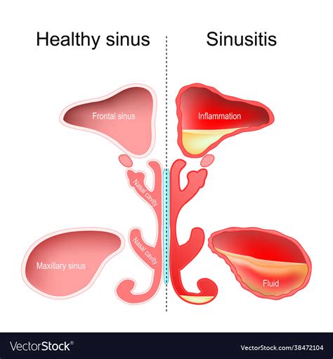 Sinusitis healthy nasal sinus Royalty Free Vector Image