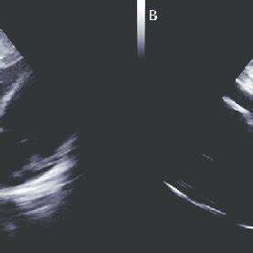 Transthoracic echocardiography, subcostal view. Spontaneous echo ...