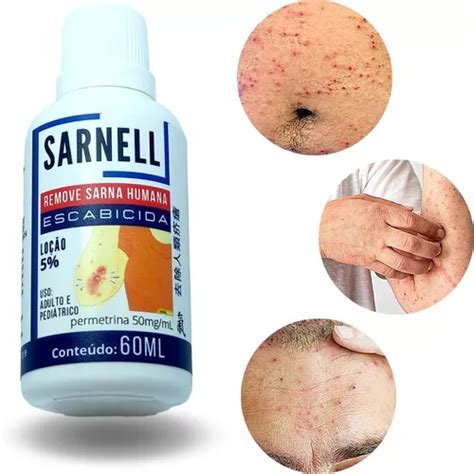 Como Acabar Com A Sarna Do Corpo Humano - Contra Sarna Humana Escabiose Acaro De Pele Alergia De Pele | MercadoLivre