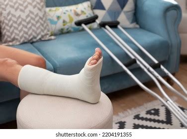 Woman Leg Cast Images Stock Photos D Objects Vectors