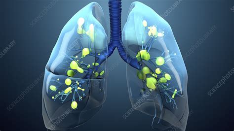 Infected Lungs Illustration Stock Image F0300548 Science Photo