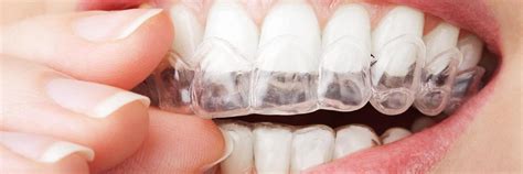 Bonita Springs Dental Blog Invisalign And Veneers Straighten Teeth