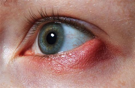 Stye Causes Symptoms Treatment And Preventive Measures