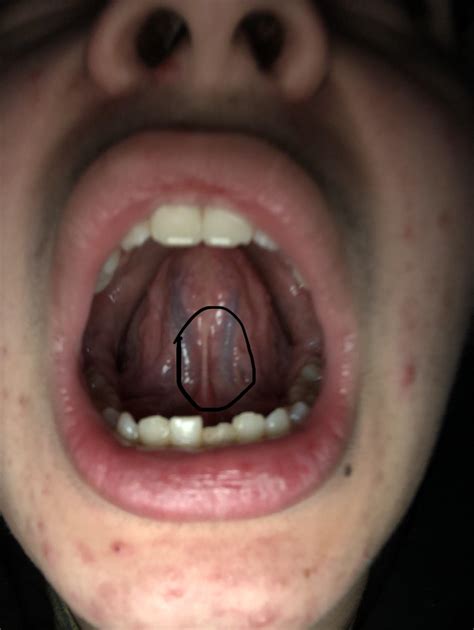 So I got tongue pain, anyone else have this issue? : r/orthotropics