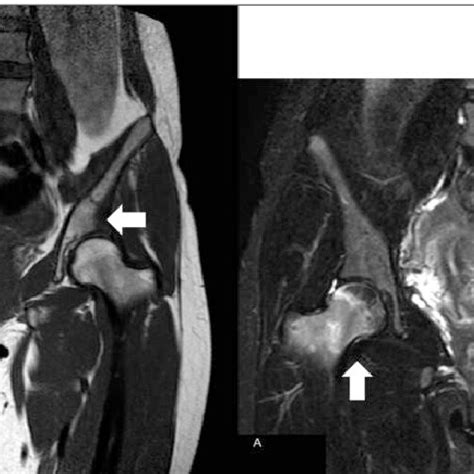 T1 study of MRI reveals a low intensity area in the right femoral head ...