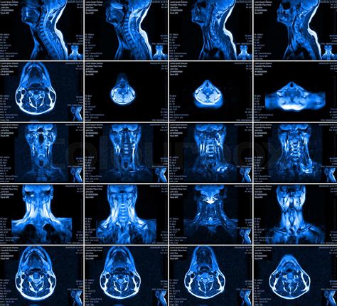 Magnetic Resonance Imaging Of The Cervical Spine Stock Image Colourbox