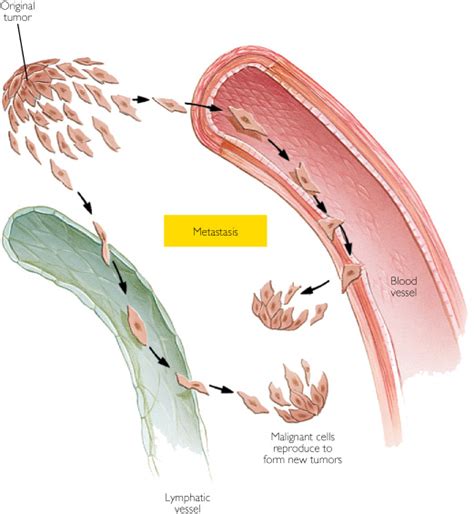 Secondary Brain Tumour | Brain Tumour Surgery