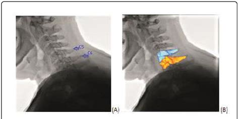 Typical 2D Angio Fluoroscopic Image In TIFF Format For A Selected Frame