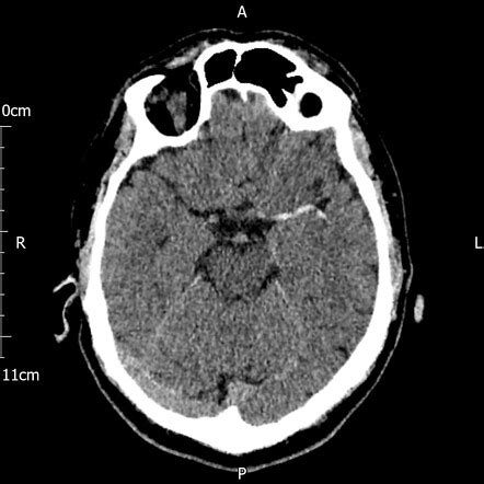 Acute MCA territory infarct | Radiology Case | Radiopaedia.org