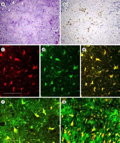 Comparative Immunohistochemical Profiles Between Podoplanin Cd And