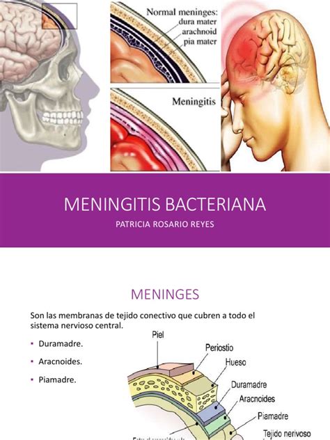 Análisis Completo De La Meningitis Bacteriana Aguda Desde Su Etiología Y Fisiopatología Hasta