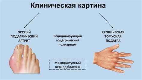 Стадии подагры