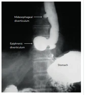 Image Based Questions On Oesophagus