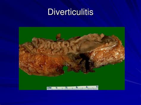 Ppt Inflammatory Bowel Disease Diverticulitis And Inflammatory Bowel Disease Powerpoint