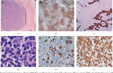 [pdf] T Cell Histiocyte Rich Large B Cell Lymphoma Of The Thymus A Diagnostic Pitfall