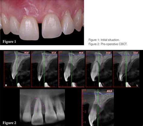 Figure From Immediate Dentoalveolar Restoration A New Perspective For