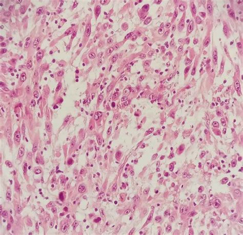 Histopathological Assessment And Ihc Analysis After H E At