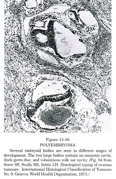 Pathology Outlines - Polyembryoma