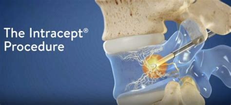 Intracept® Procedure for Chronic Lower Back Pain | DISC