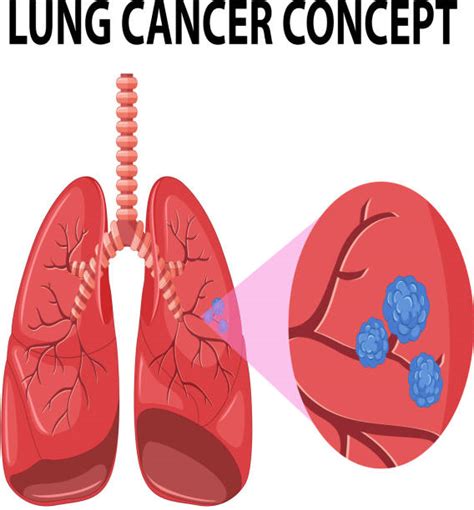 List 101 Pictures Photos Of Lung Cancer Stunning