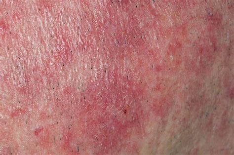 Rosacea Rash On The Face Photograph By Dr P Marazziscience Photo Library