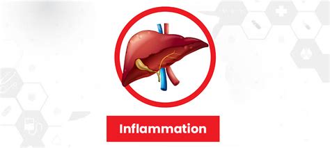 What Are The Stages of Liver Disease